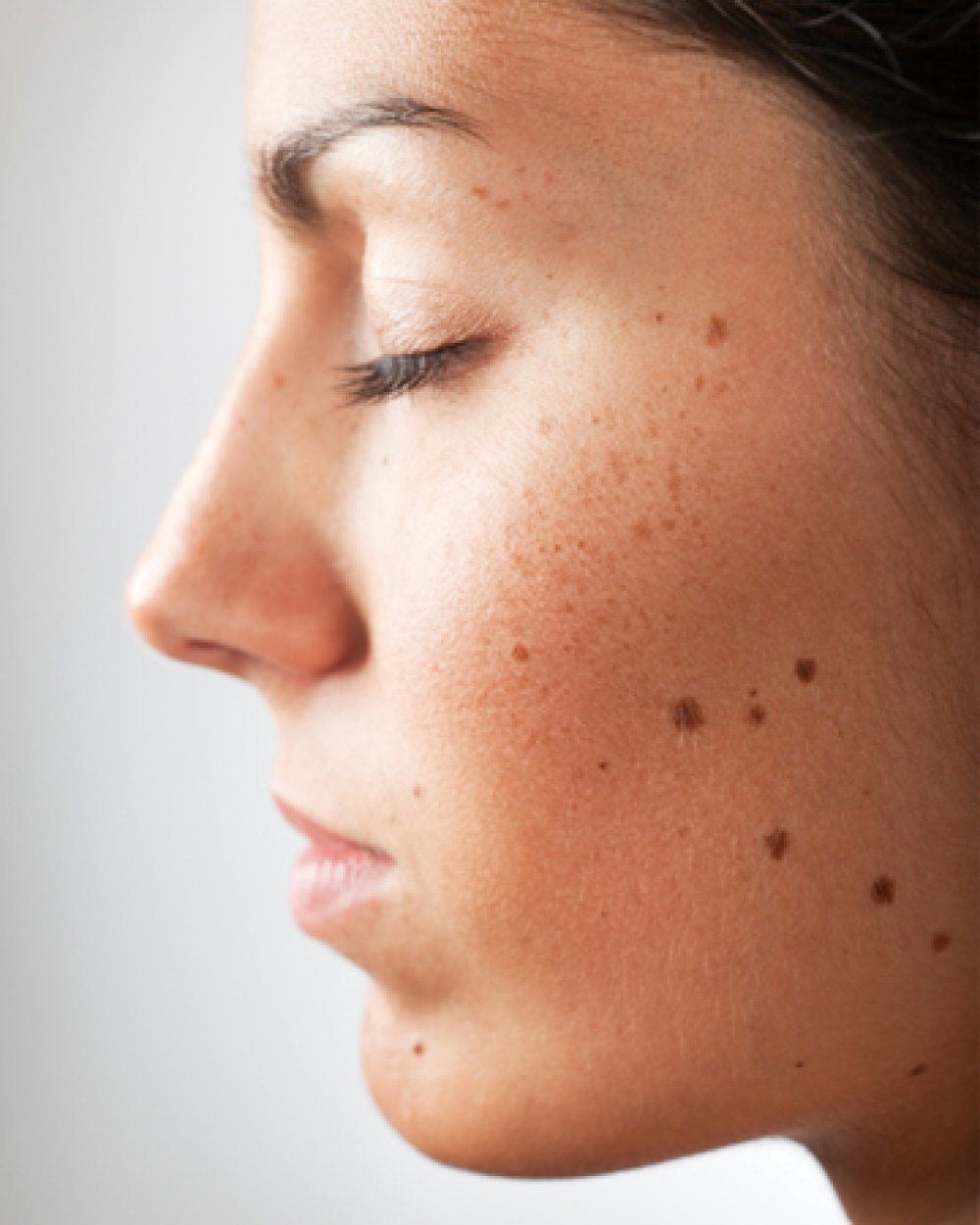 Skin tag removal